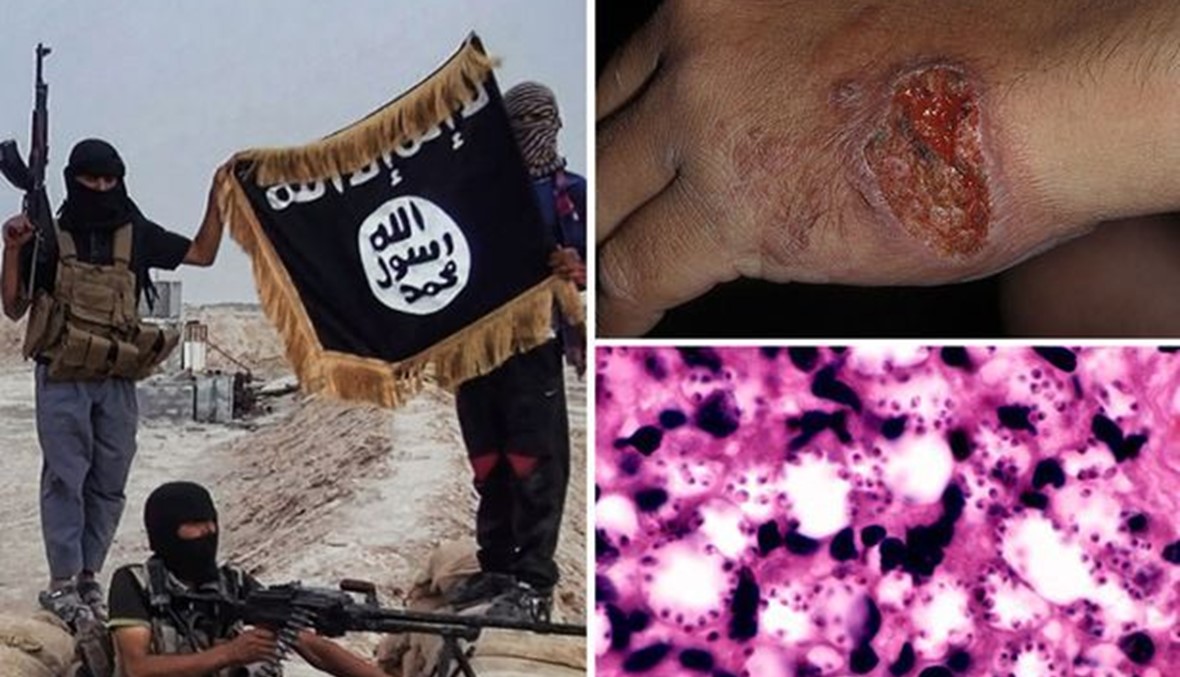 ما هو مرض اللشمانيا الذي يهدد "داعش"؟