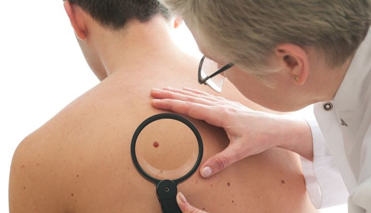 سرطان الجلد: لا للاستئصال