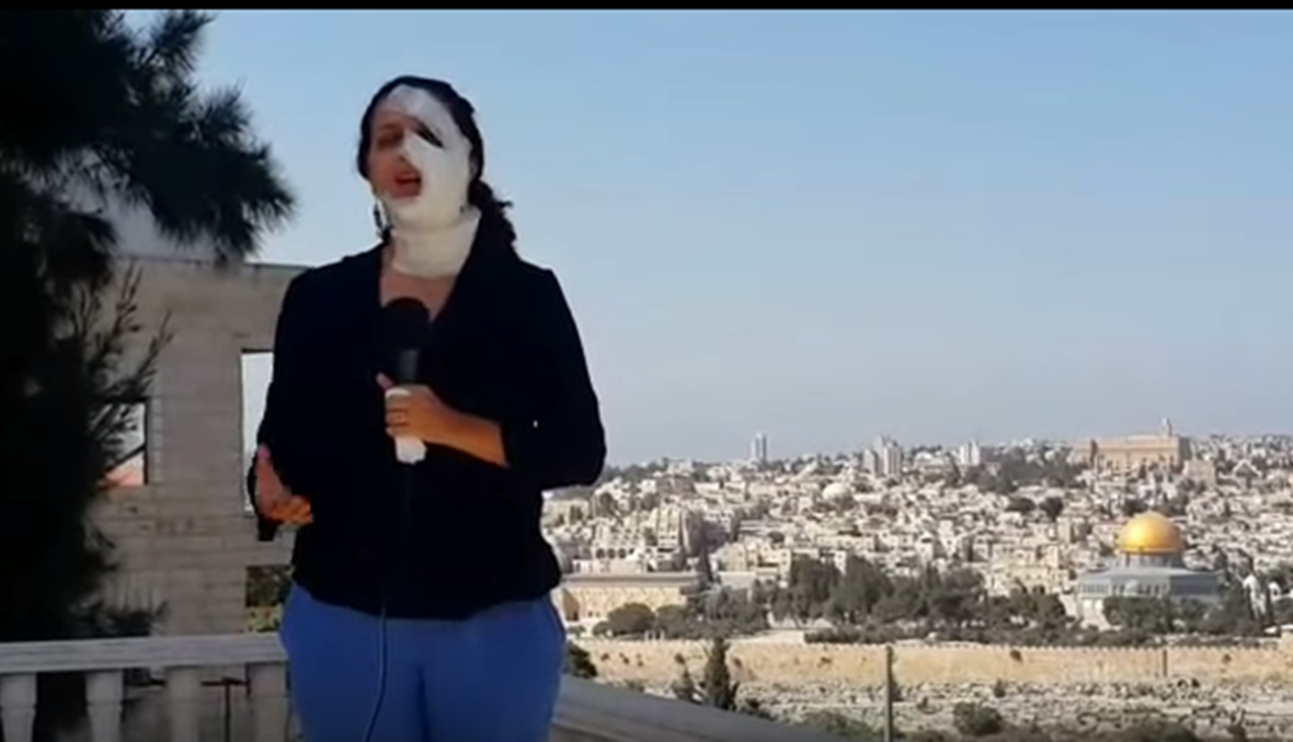 بالفيديو: رغم الحروق على وجهها... الصحافية هناء محاميد تتابع رسالتها
