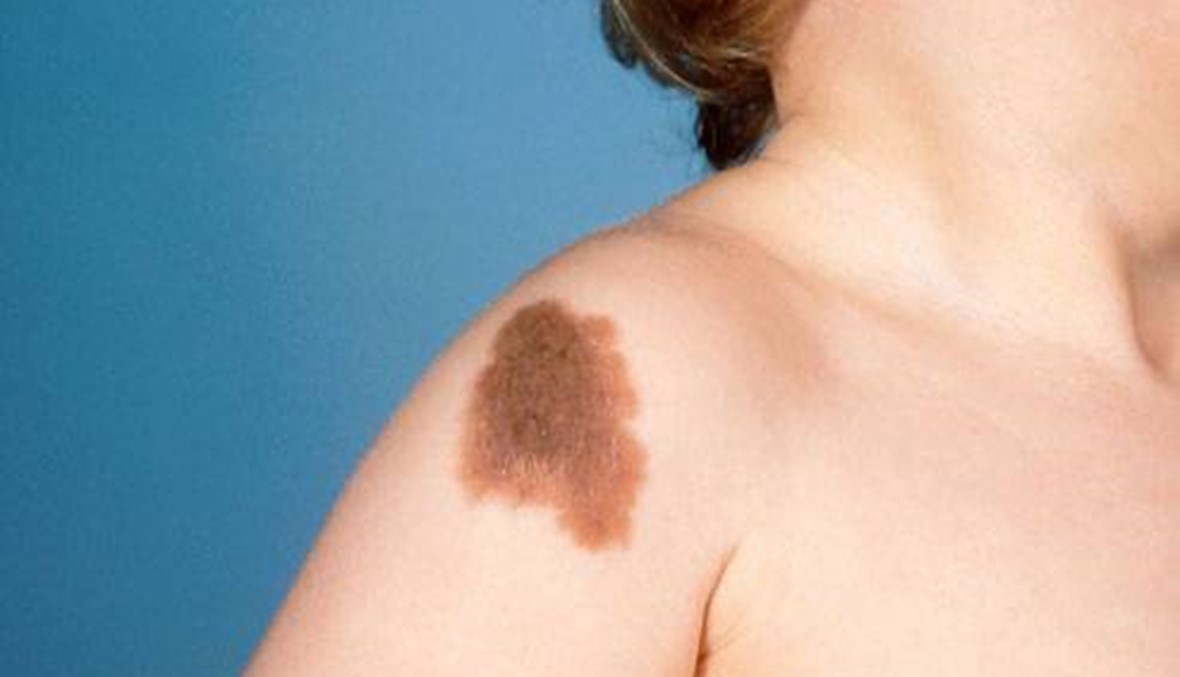 الوحمات البنية ليست جميعها بريئة... والشهوة خرافة اجتماعية؟!