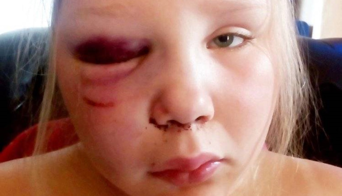 انقلبت المزلجة على رأسها... ابنة السنوات التسع تعرّضت لتسعة كسور في وجهها!