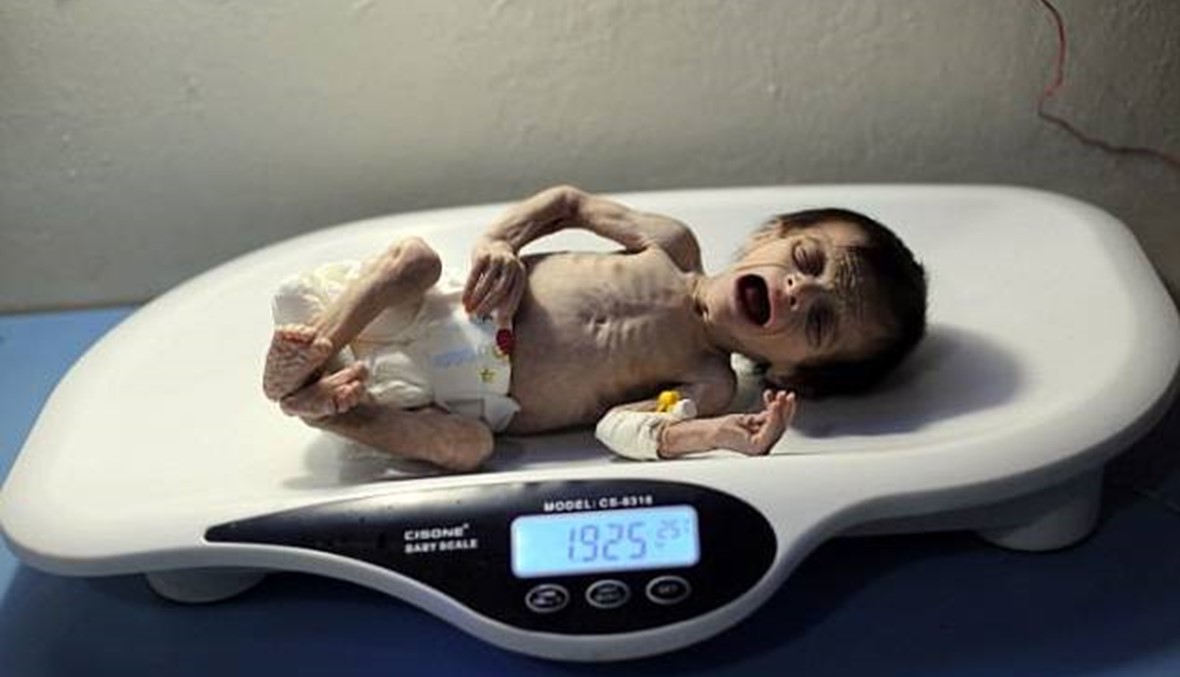 صور مأسوية لرضيع سوري يعاني من سوء التغذية تجتاح مواقع التواصل