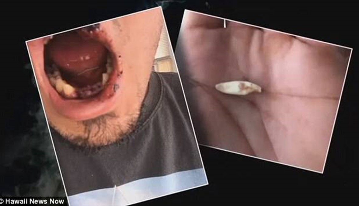فقد أربعة من أسنانه و 40 قطبة بعدما انفجرت السيجارة الالكترونية في فمه