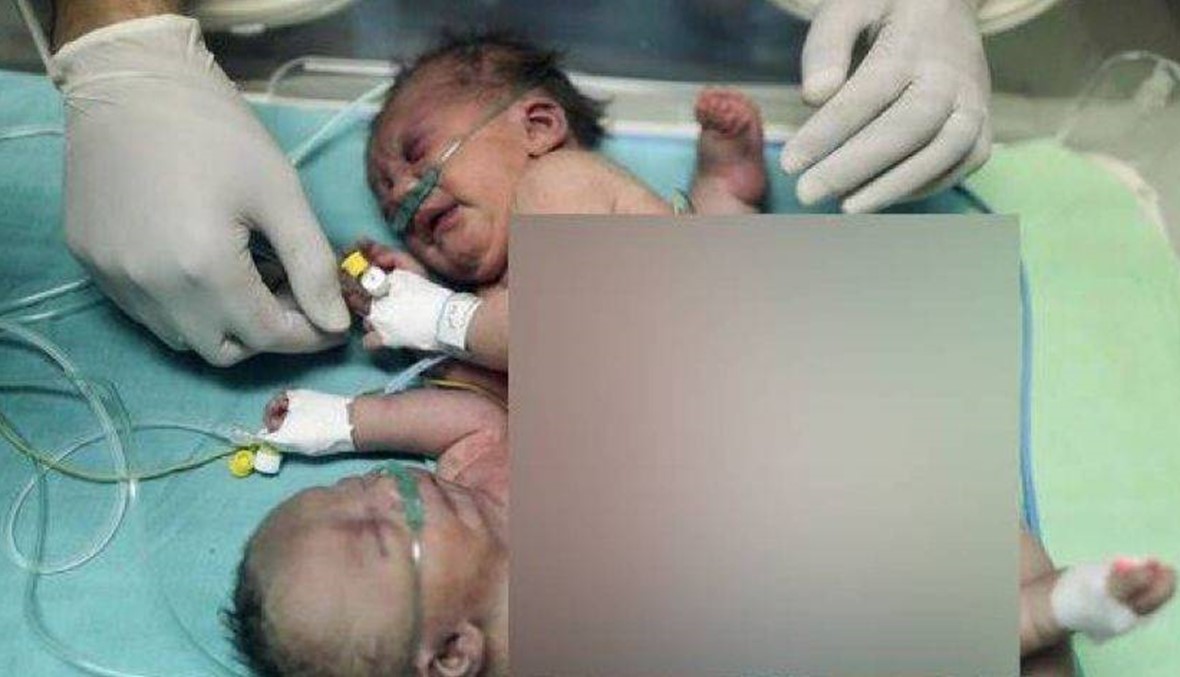 إحدى الشقيقتين الفلسطينيتين في حالة "موت سريري" بعد عملية فصل التوأمين في الرياض