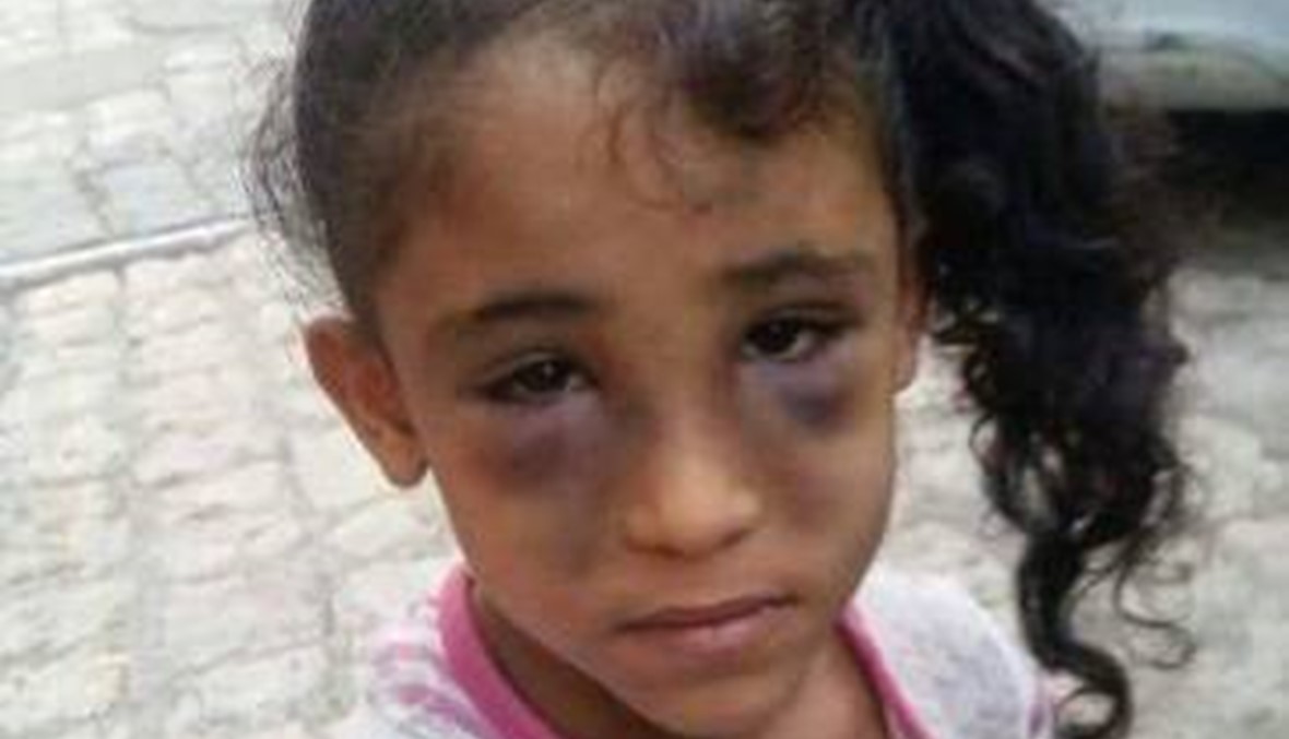 صور طفلة عذبها والدها بوحشية تشعل مواقع التواصل الاجتماعي
