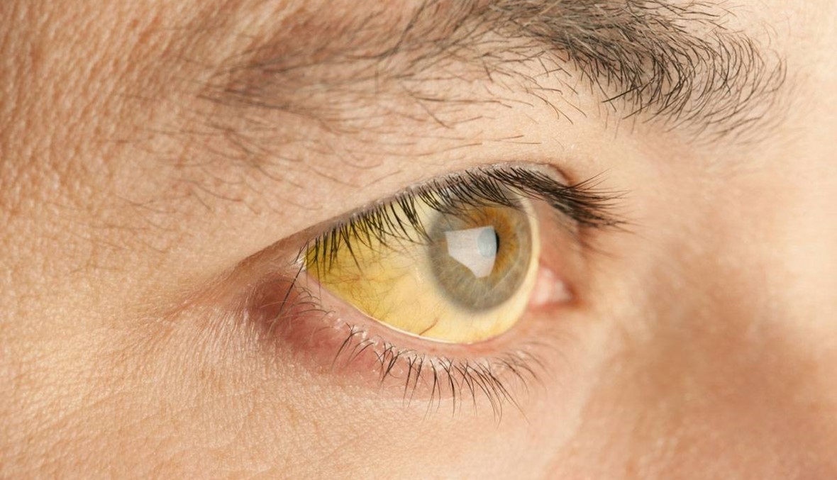 ظهور مرض "اليرقان" في عين الذهب... ما علاقة المياه بهذه الإصابات؟