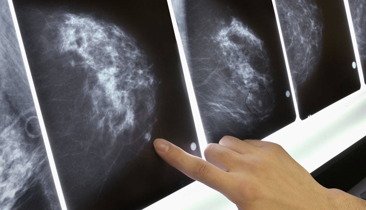 هل فقدان الوزن يقلل احتمالات الإصابة بسرطان الثدي؟
