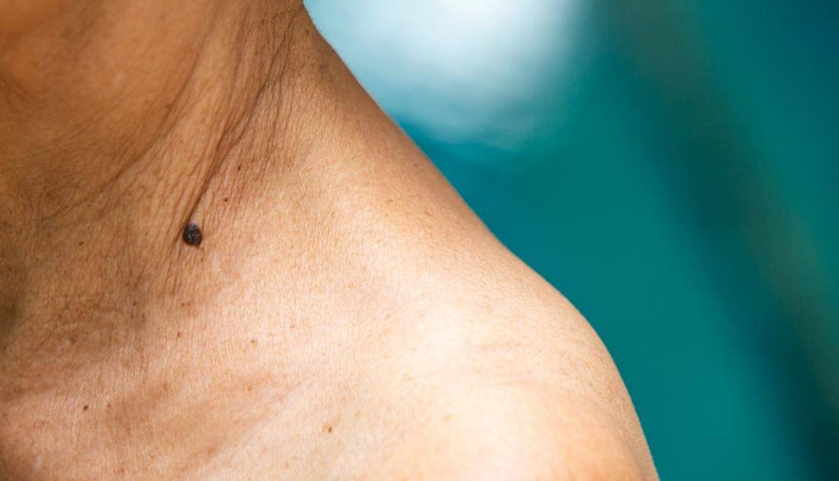 اكتشاف تركيبة دواء لمحاربة سرطان الجلد