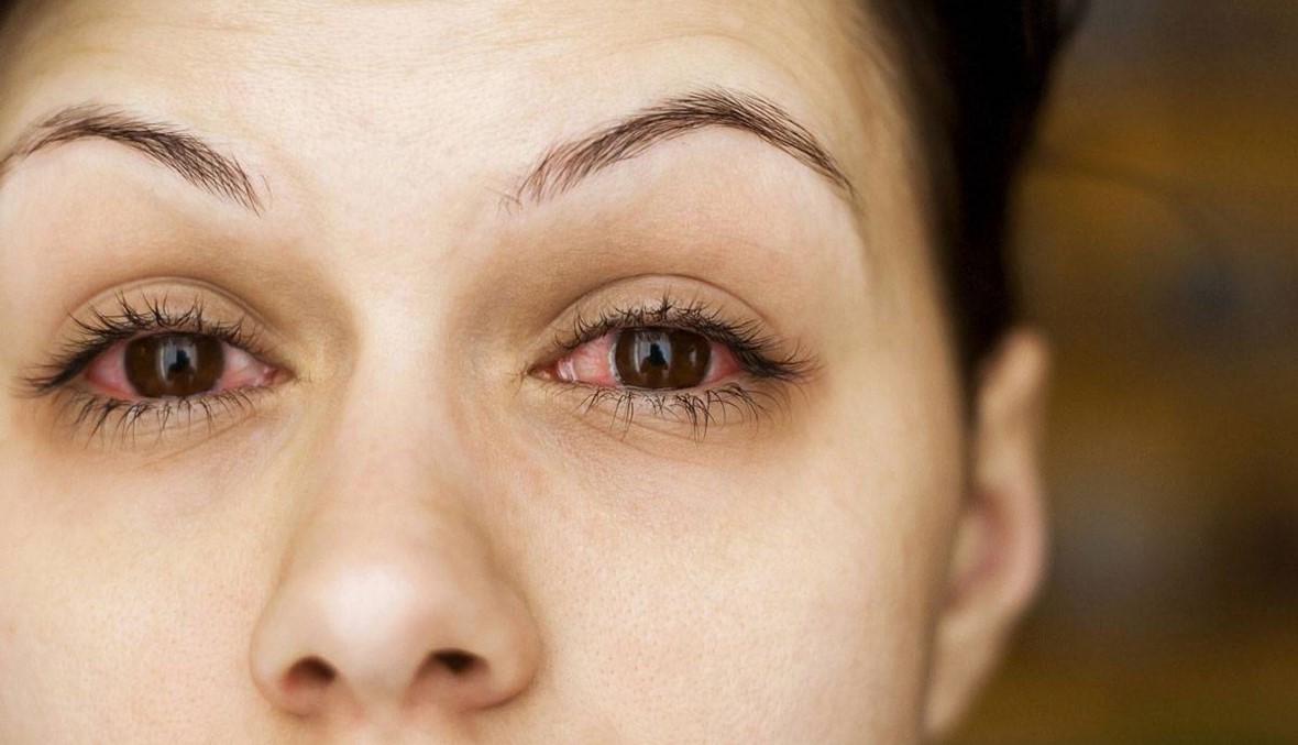 كيف تعالج حساسية العين؟