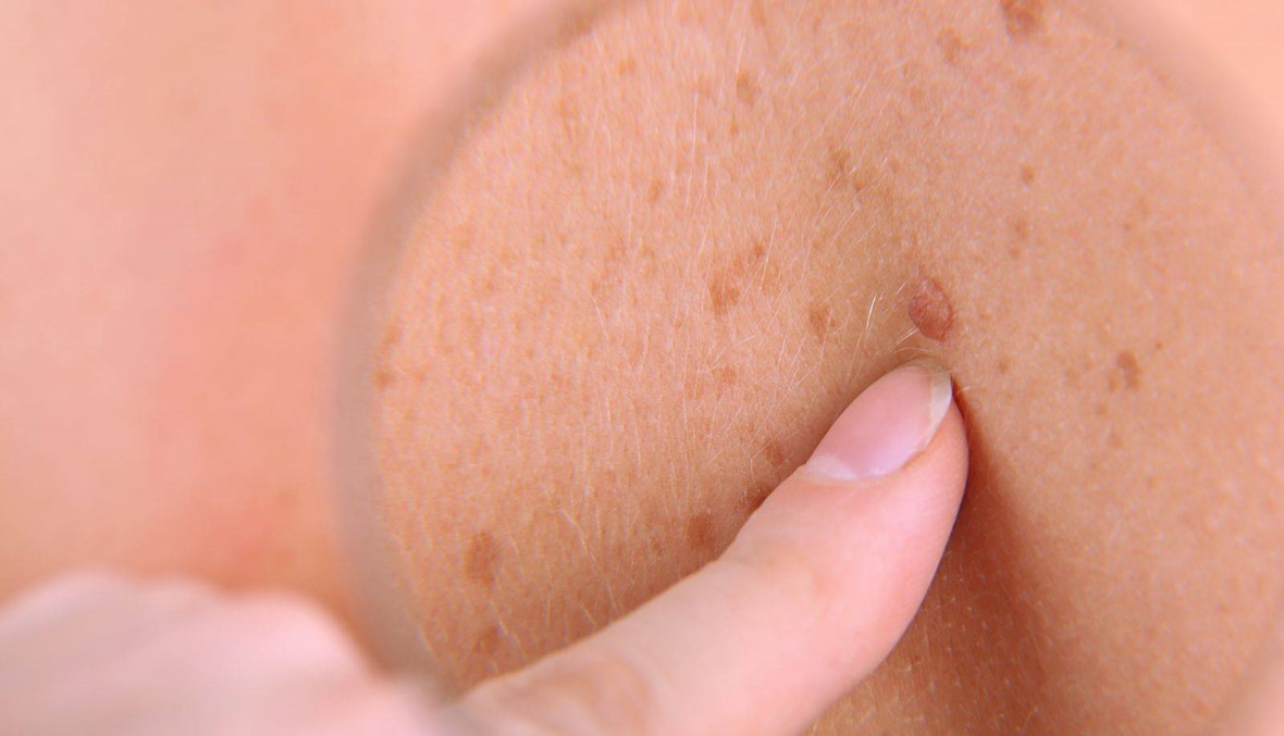 صحة- السبب الرئيسي لسرطان الجلد بات واضحاً... والوقاية ممكنة