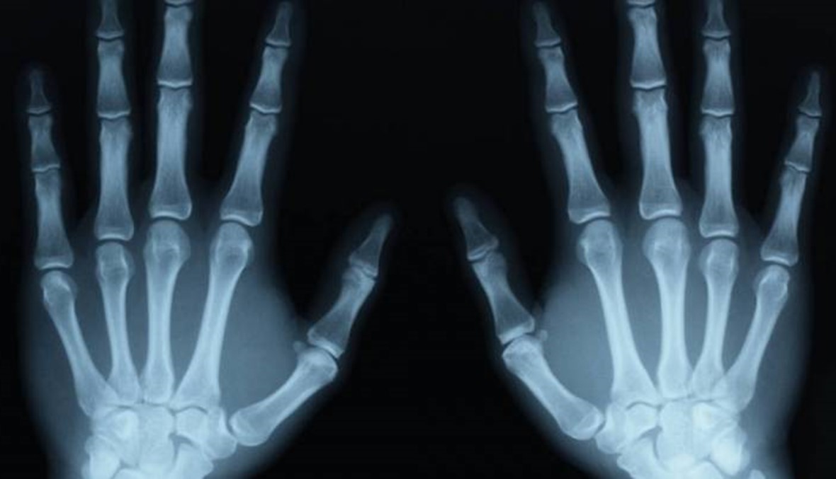 هل تسبّب طقطقة الأصابع التهاباً في المفاصل؟