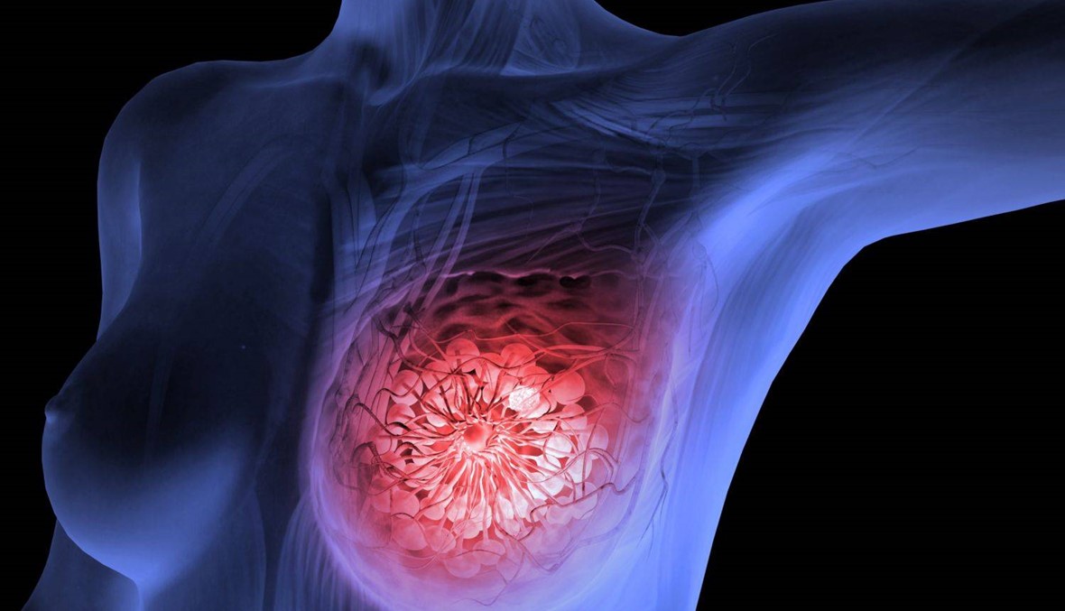 الأسبرين قد ينقذ بعض مريضات سرطان الثدي فيما يجعل حالة أخريات اسوأ بعد