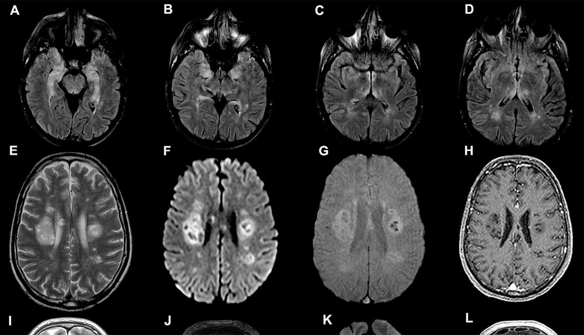 مسح دماغي لمريض بكورونا تُظهر أن إصابته بمضاعفات عصبية خطيرة، بما في ذلك تلف الأعصاب.