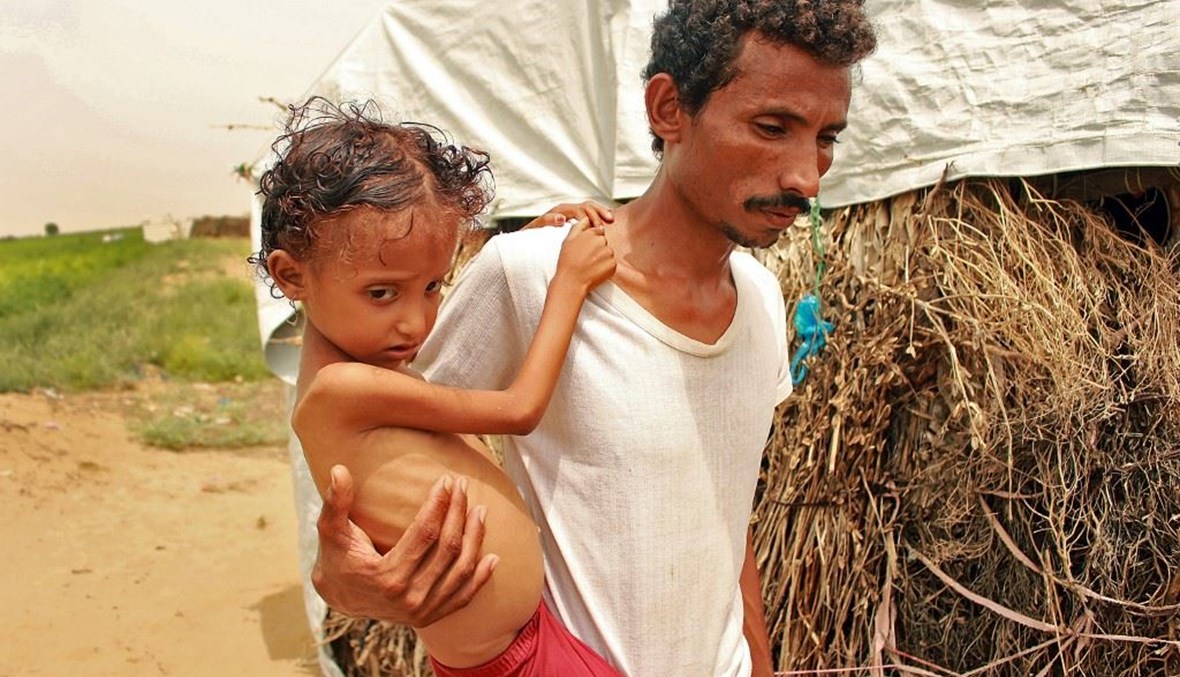 سوء تغذية في اليمن (أ ف ب).