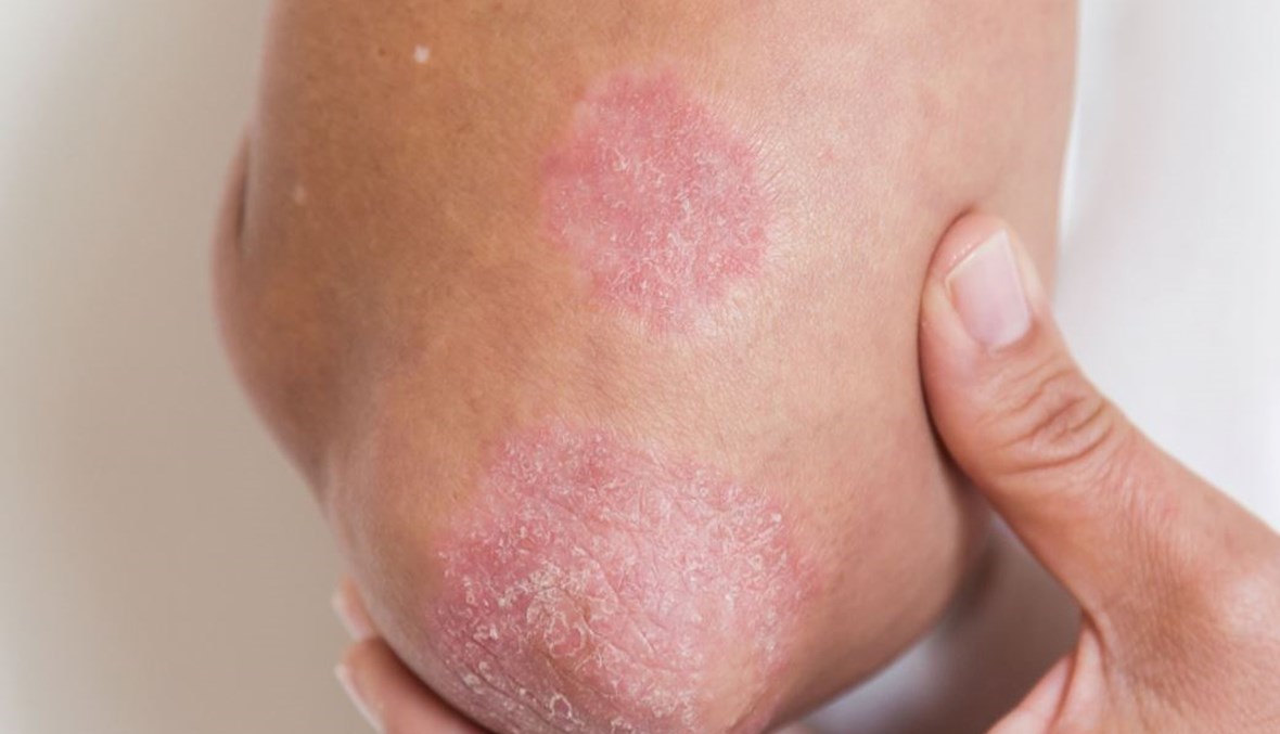 مرض عليك التأقلم معه... أشعة الشمس وعوامل أخرى تحسّن حالة الصدفية