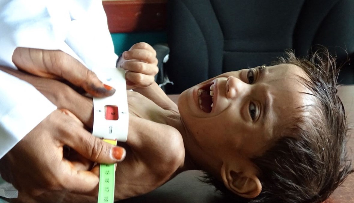 الطفل اليمني أحمد عبده سالم (عامان) الذي يعاني سوء تغذية خلال معاينته في عيادة في محافظة الحديدة الغربية (15 شباط 2021، أ ف ب) . 
