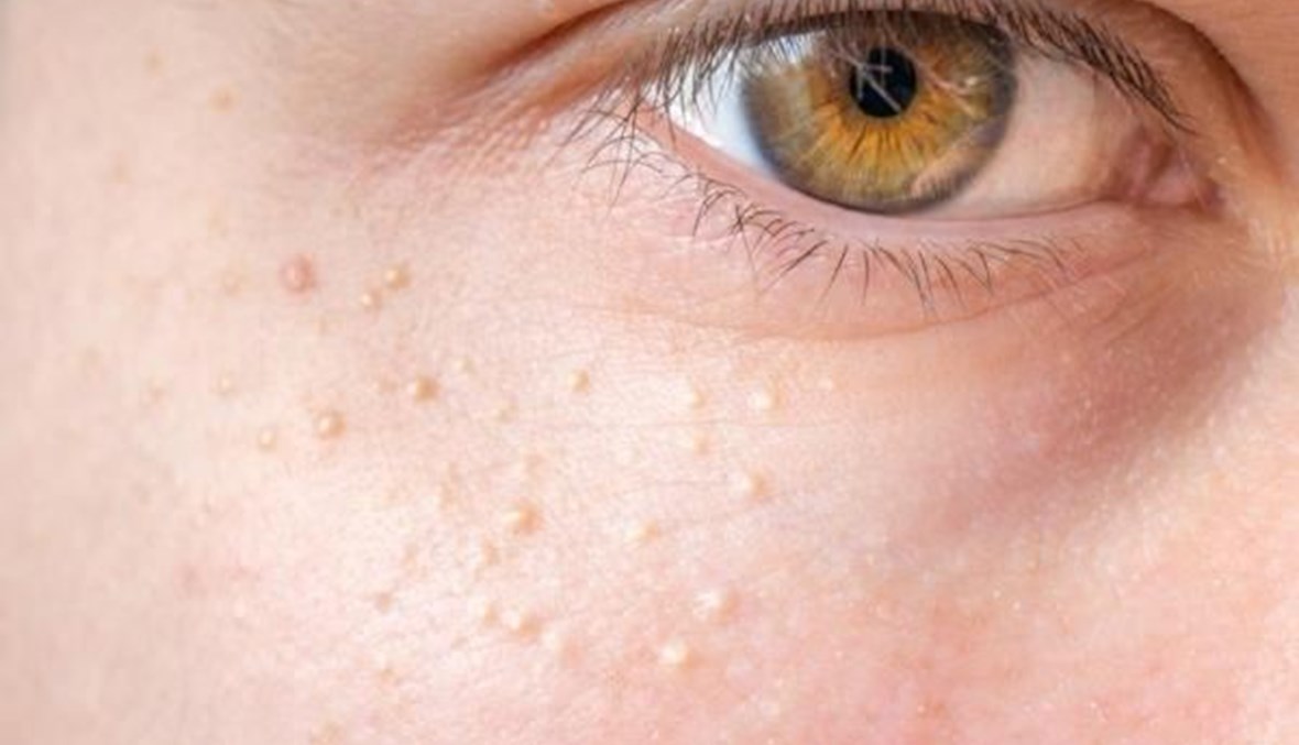 هكذا تتخلّصين من الأكياس الدهنية تحت العين من دون جراحة!