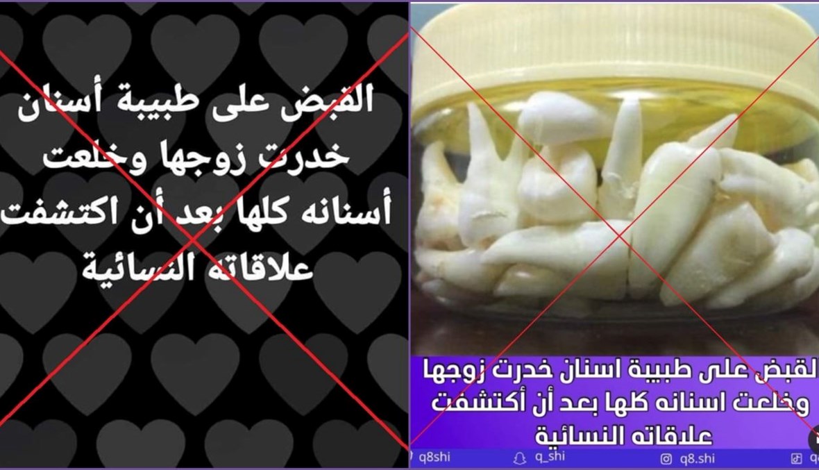 ما حقيقة "القبض على طبيبة أسنان خدّرت زوجها وخلعت كلّ أسنانه" انتقاماً؟ FactCheck#