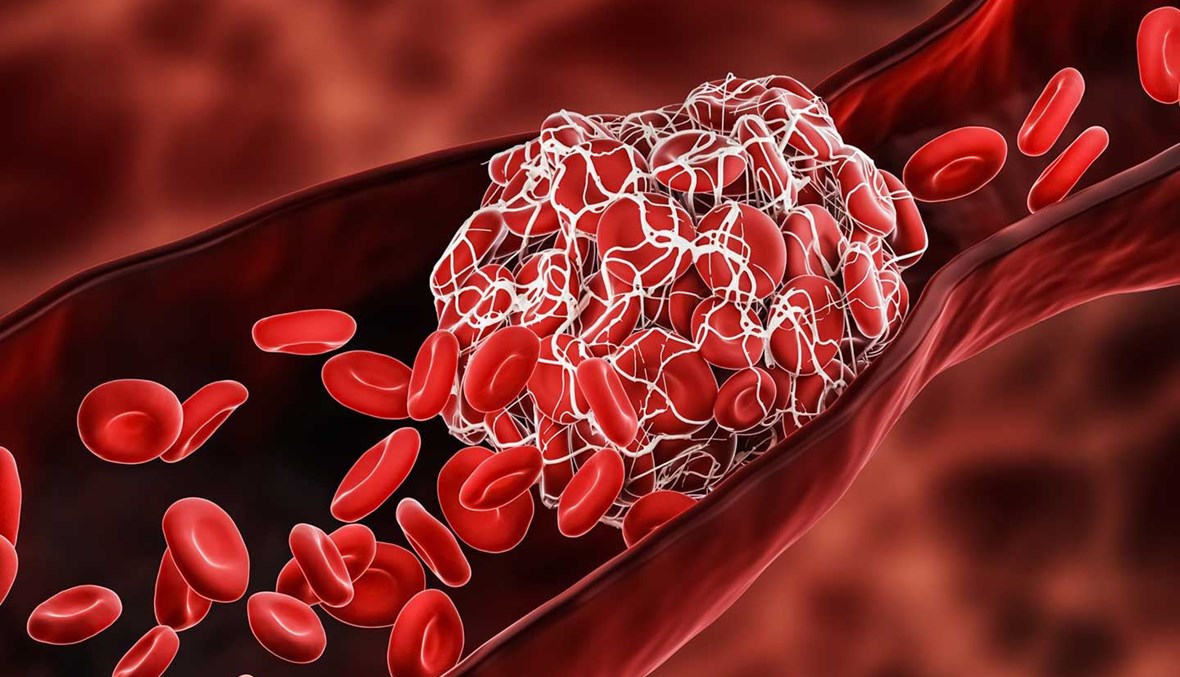 في دراسة جديدة... خطر الجلطات يستمرّ أشهراً بعد الإصابة بكورونا